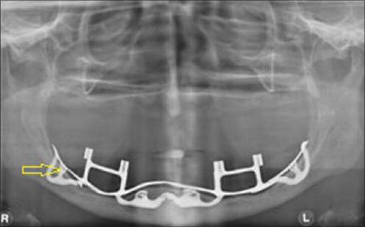 65-year-old female with completely edentulous maxillary and mandibular arches. Panoramic radiograph demonstrates a mandibular subperiosteal implant (arrows).